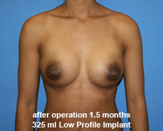 plastic-surgery-breast-augmentation